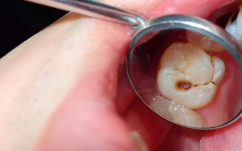 Why You Should Never Ignore a Small Cavity: Recognizing Early Cavity Warning Signs